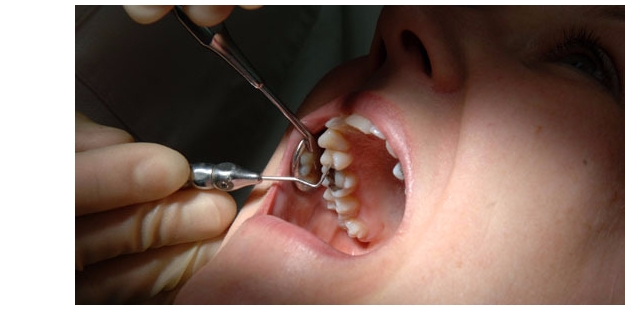 Çürük Diş Çoğu Organı Olumsuz Etkiliyor