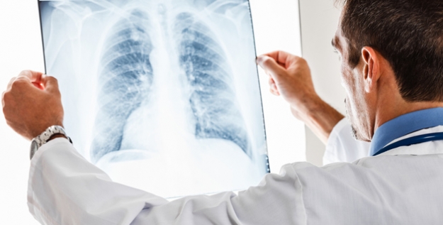 Akciğer Kanserinde Yeni Tedaviler Umut Veriyor!