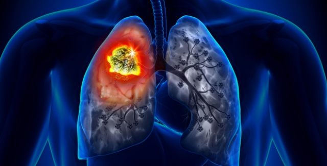 Akciğer Kanserinden Korunmanın Yolları