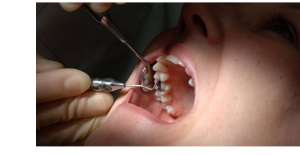 Çürük Diş Çoğu Organı Olumsuz Etkiliyor